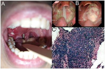 Case report: A rare EBV-associated T/NK cell monomorphic posttransplant lymphoproliferative disorder